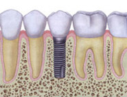 Implants Image 1